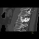Osteolytic metastasis of pedicle: CT - Computed tomography